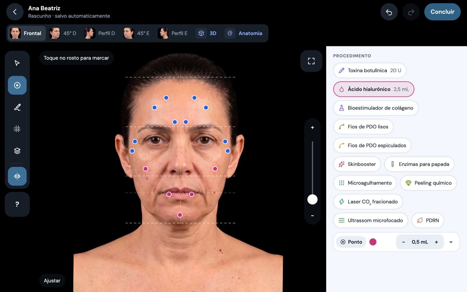 Editor do Facyo: pontos de toxina e de preenchimento marcados sobre a foto de um modelo de treino